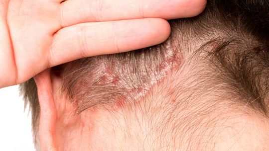Krwawienie skóry głowy – konsekwencja nadmiernego drapania?