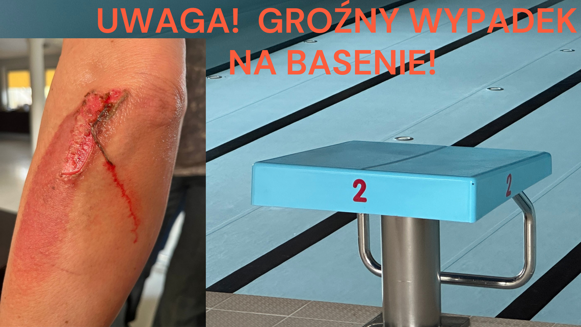 Kobieta poślizgnęła się w saunie i doznała poparzenia II stopnia